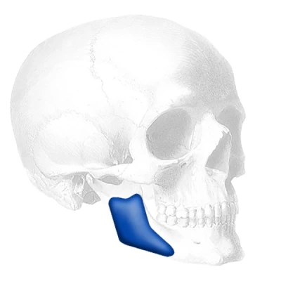 TMA Posterior Mandibular Çene İmplantı | Lateral Mandibular Angle™